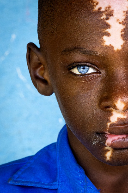 Portrait de demi-visage d'une jeune personne à la peau foncée avec des taches de vitiligo, présentant un œil bleu vif regardant directement l'appareil photo, portant une chemise bleue sur fond de ciel bleu clair