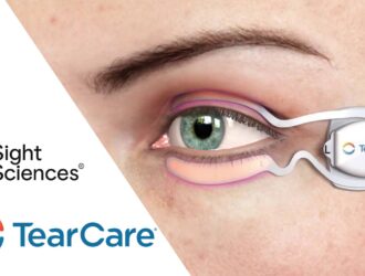 Dispositif Sight Sciences TearCare SmartLids appliqué sur les paupières pour le traitement du dysfonctionnement des glandes de Meibomius et de la sécheresse oculaire