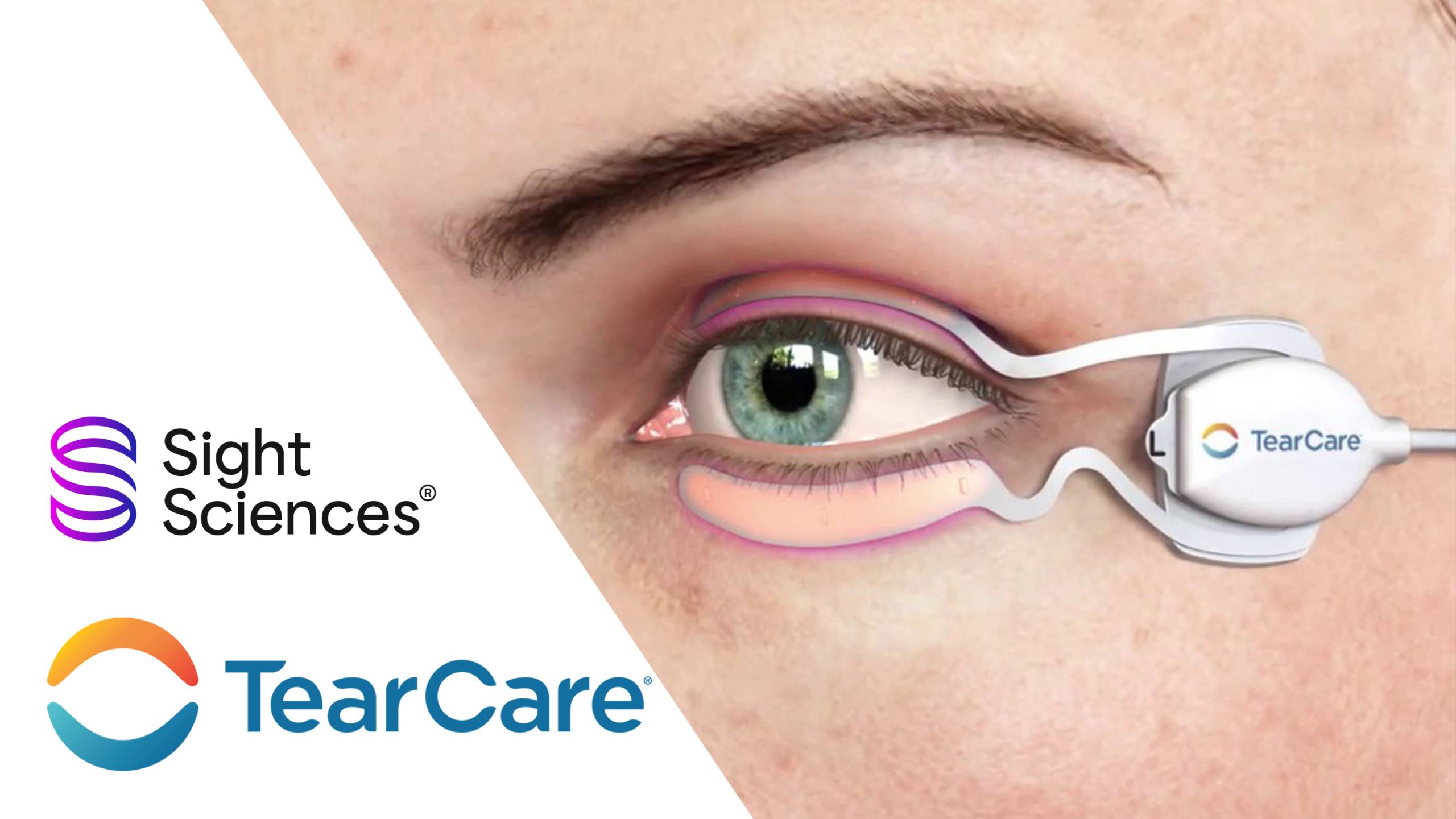 Sight Sciences TearCare System SmartLids device applied to patient eyelids for meibomian gland dysfunction and evaporative dry eye treatment