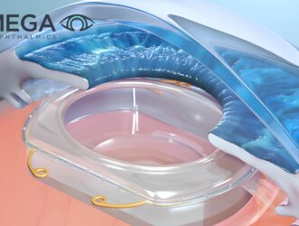 3D medical illustration of the Omega Ophthalmics Gemini Refractive Capsule implanted inside the human eye for cataract surgery.