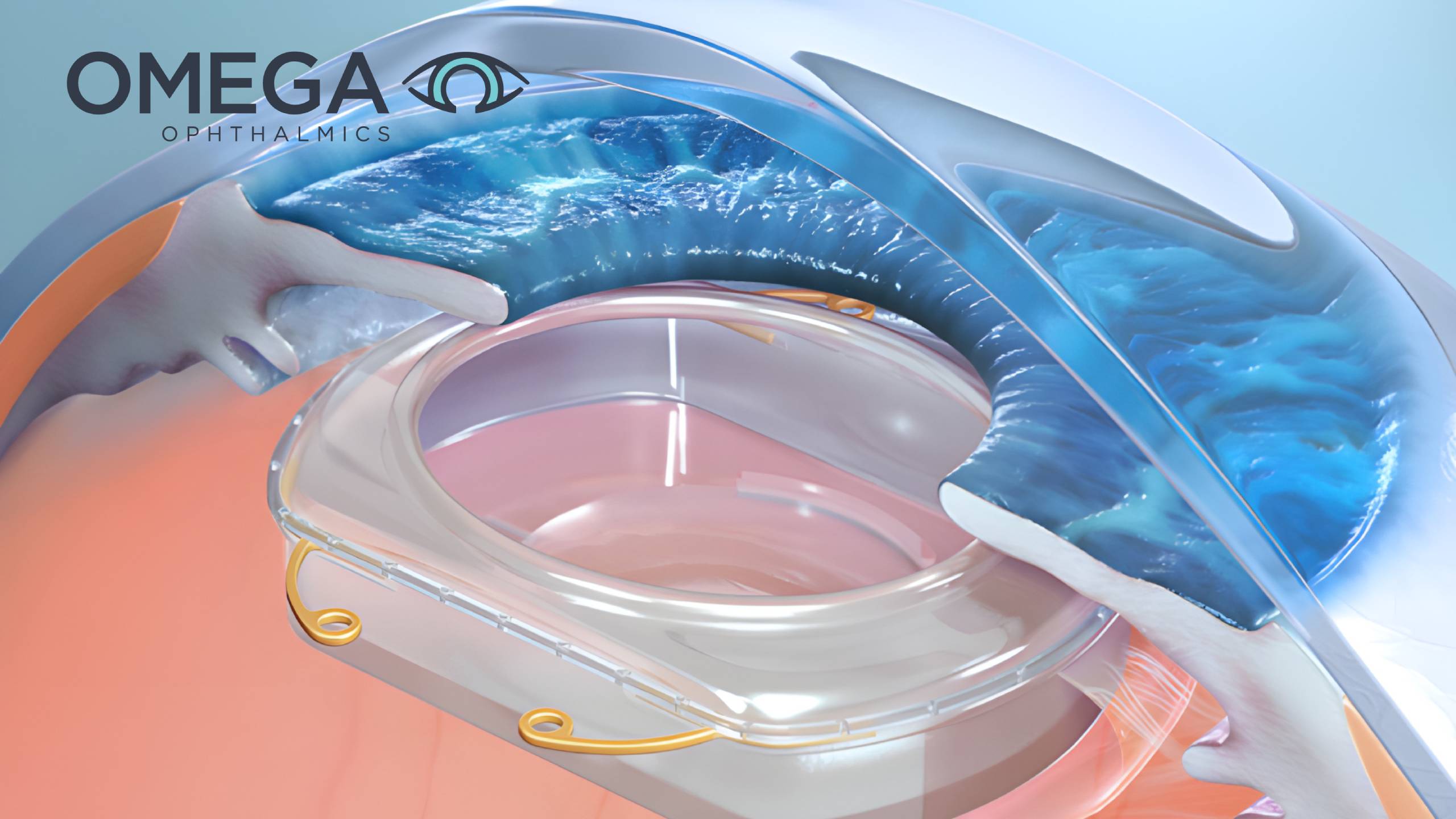 3D medical illustration of the Omega Ophthalmics Gemini Refractive Capsule implanted inside the human eye for cataract surgery.