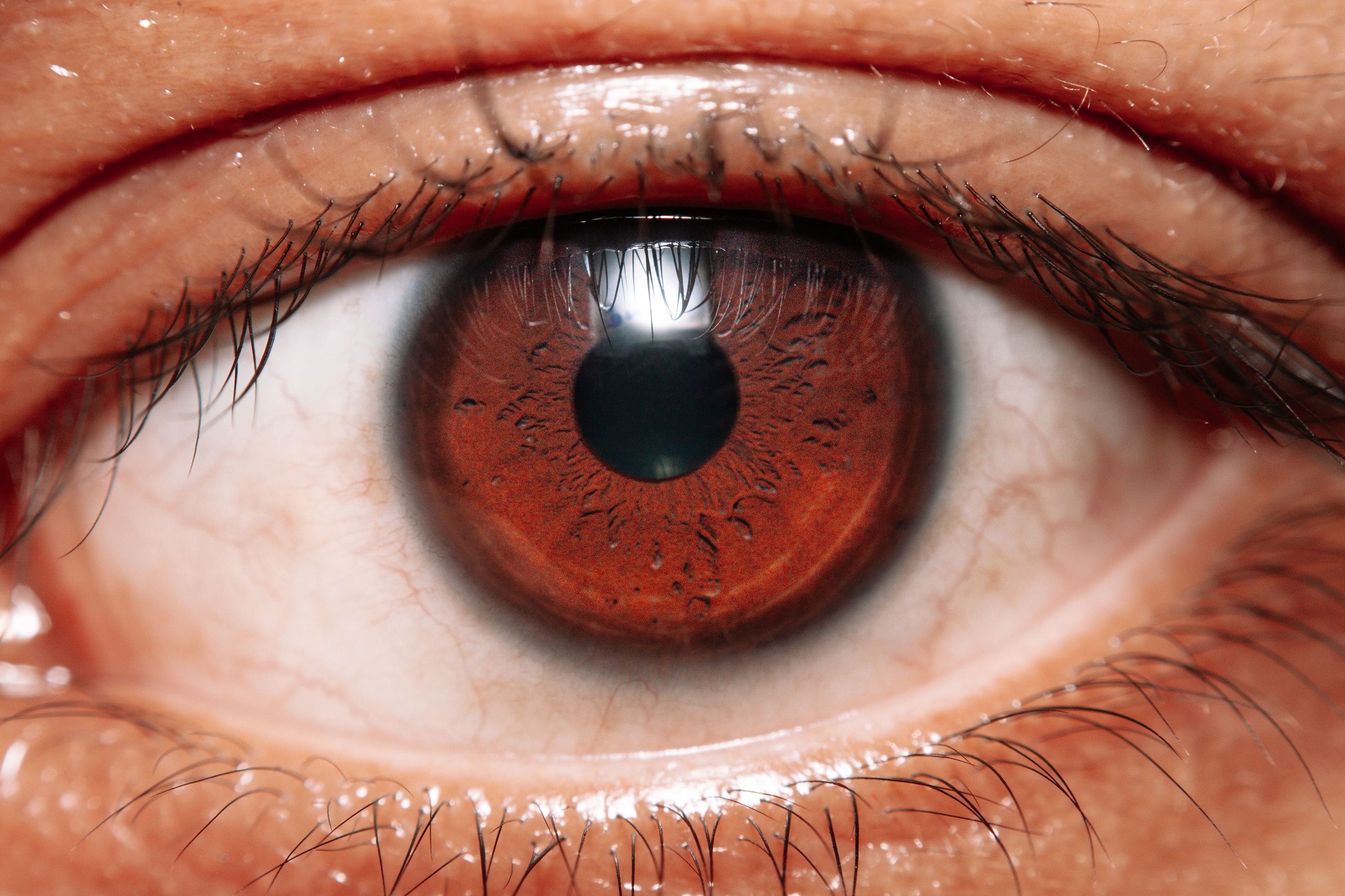 Image macro d'un œil humain rouge et irrité causé par la sécheresse oculaire et la blépharite.